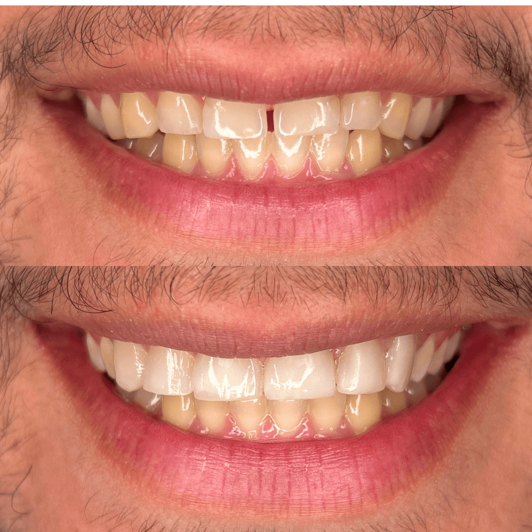 Resultado de facetas em resina — antes e depois