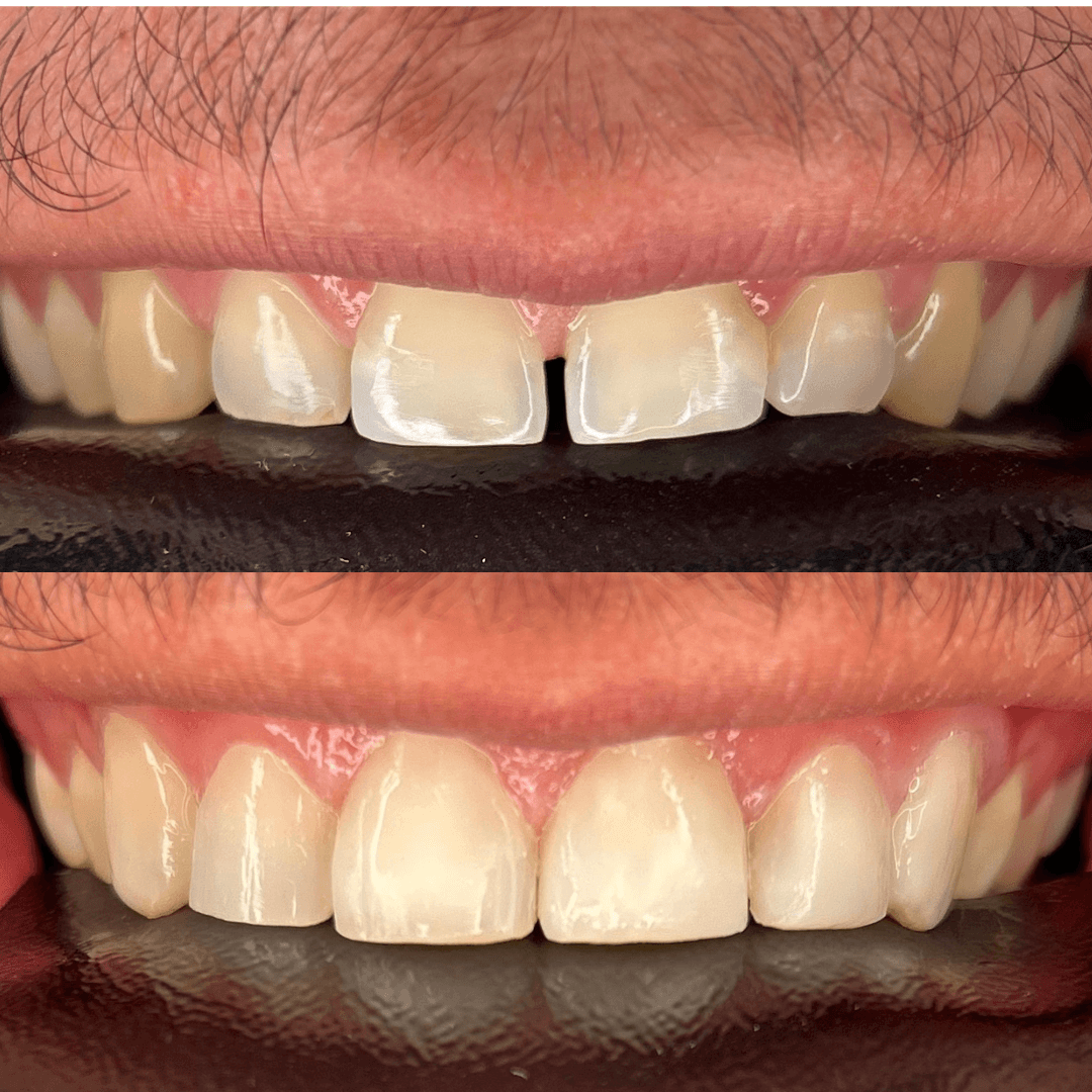 Resultado de restauração estética — antes e depois